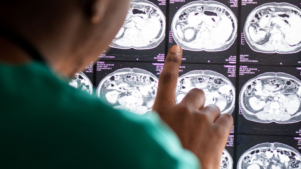 nvestigadores del Reino Unido hallaron -a través de resonancias magnéticas a cerca de 785 pacientes contagiados- que el tamaño total del cerebro se reduce.